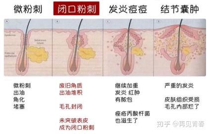 如何改善闭口？ - 知乎