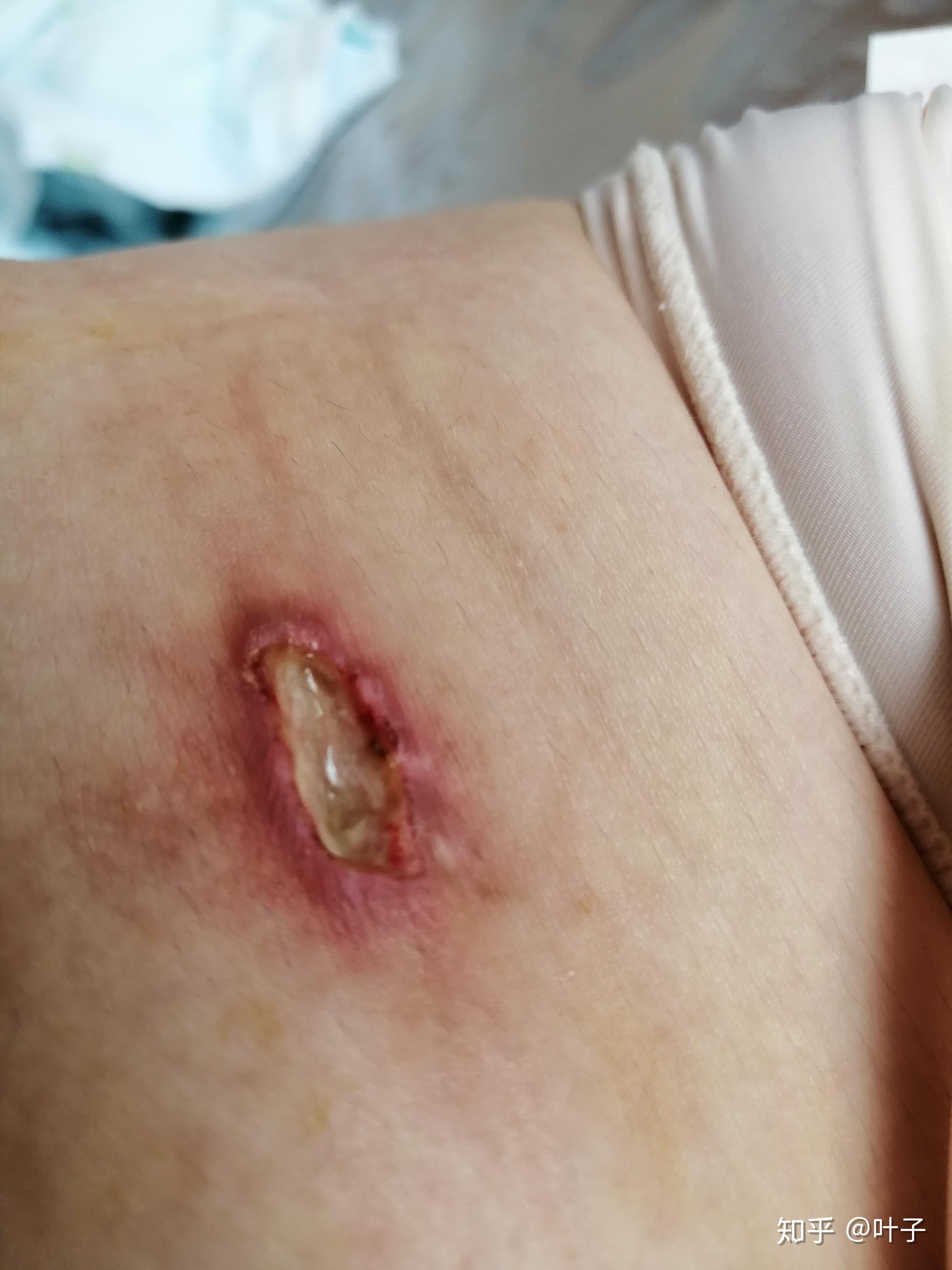 女人卵巢囊肿刀口图片图片