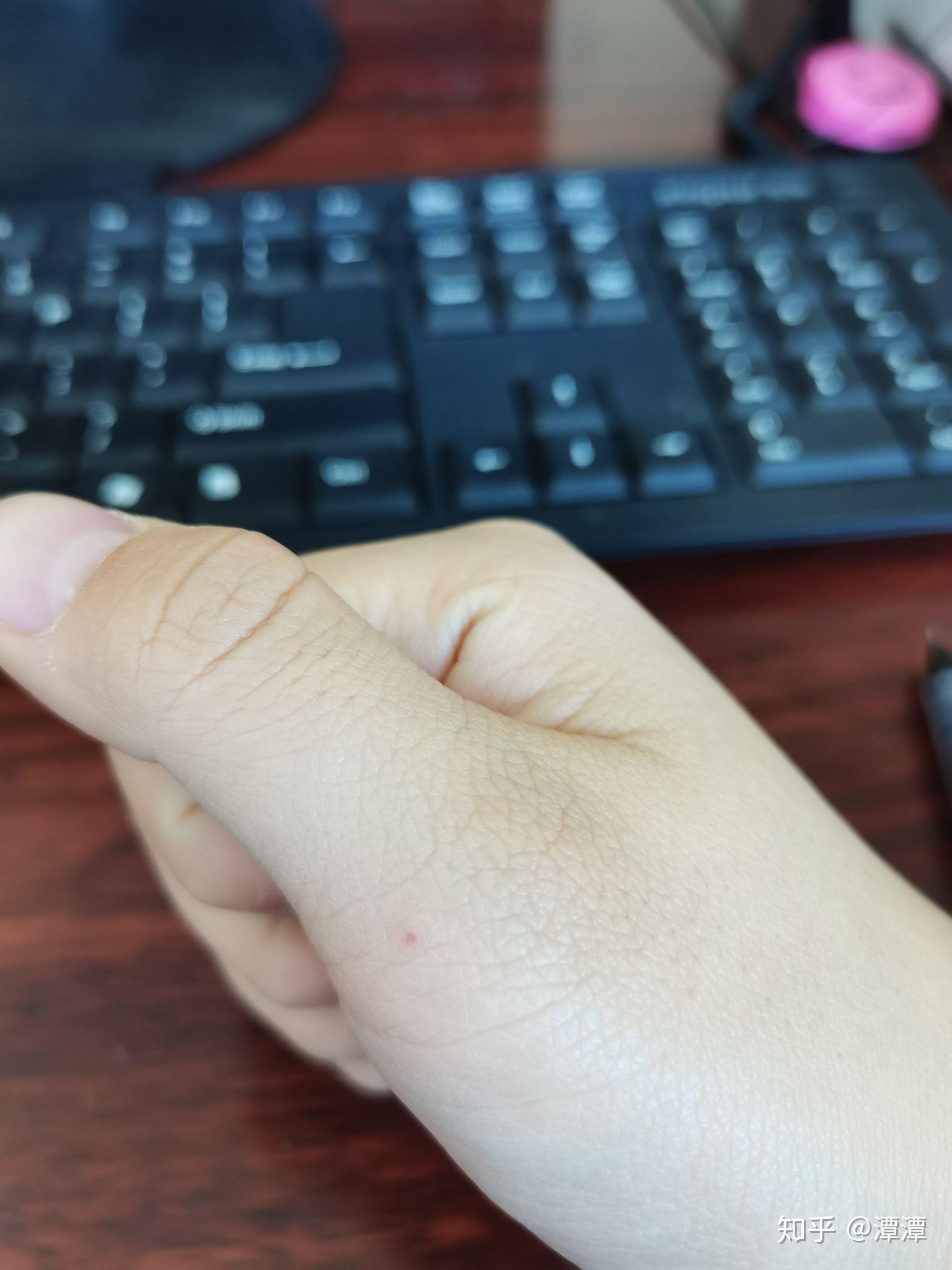 手上长的红痣是什么原因? - 知乎