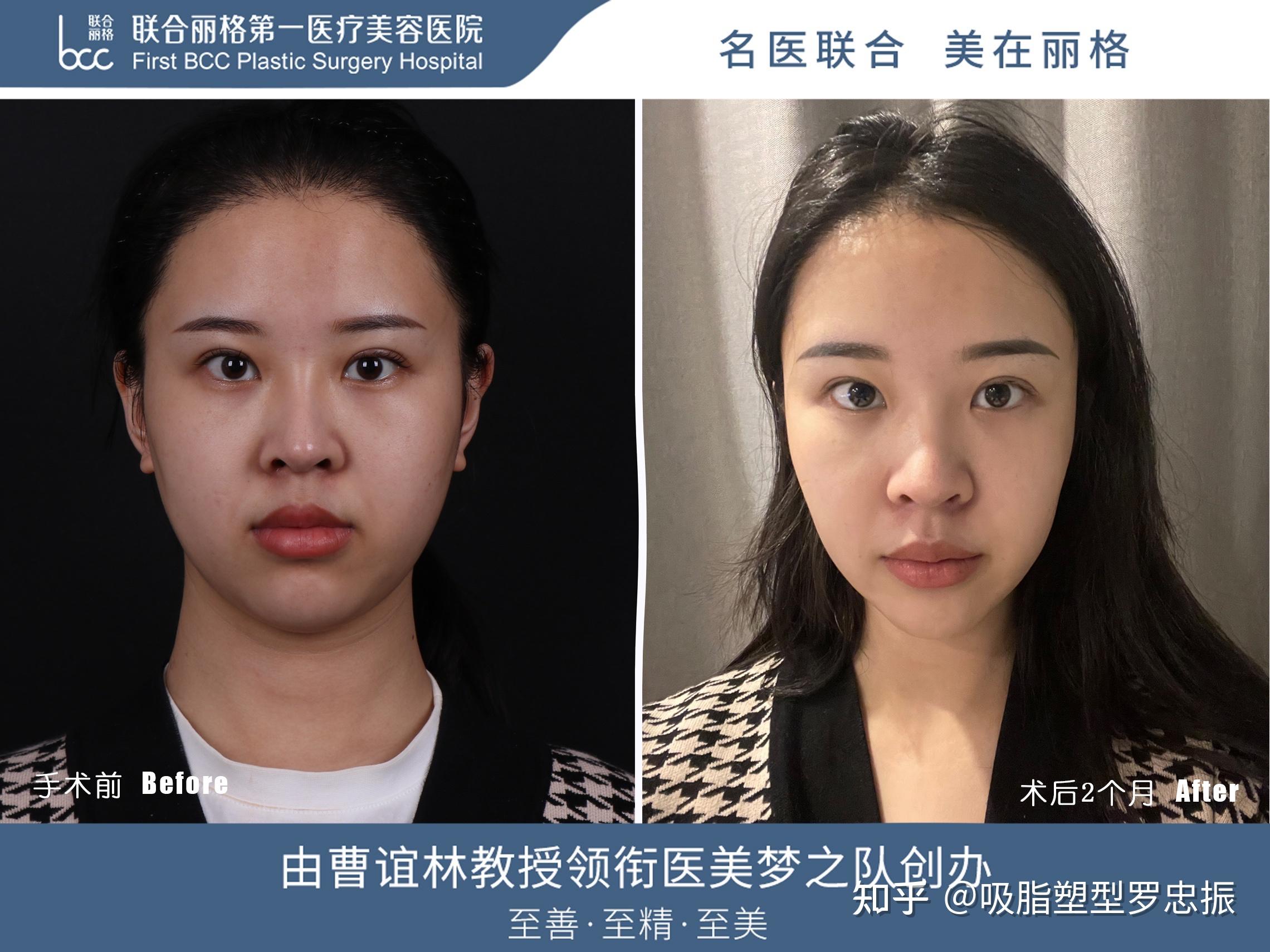 在韩国做面部吸脂+全脸脂肪填充花了4.5万元，三天回国后恢复的越来越自然 - 美佳网