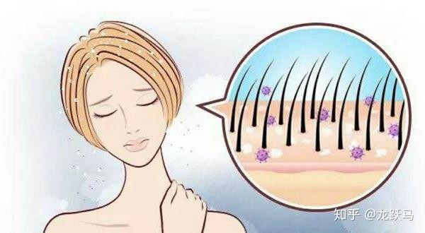 头皮屑 干燥的头皮头皮也需要在冬季战干燥弄清头皮屑真相 知乎