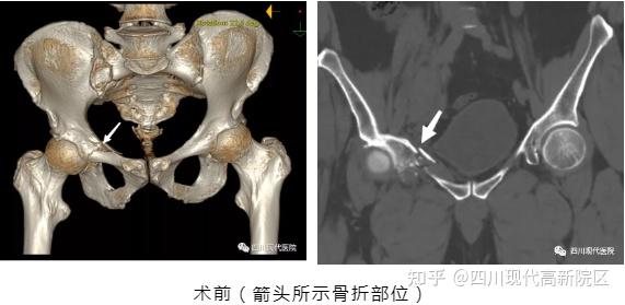 主要診斷為右恥骨上支粉碎性骨折,右骶骨翼粉碎性骨折,右坐骨支骨折