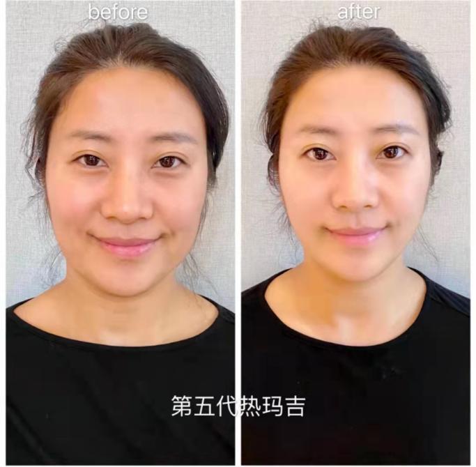 超火的半岛超声炮避坑指南,超声炮vs热玛吉价格,效果全面对比