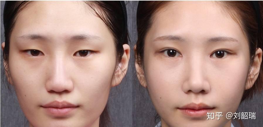 什么是内眦赘皮