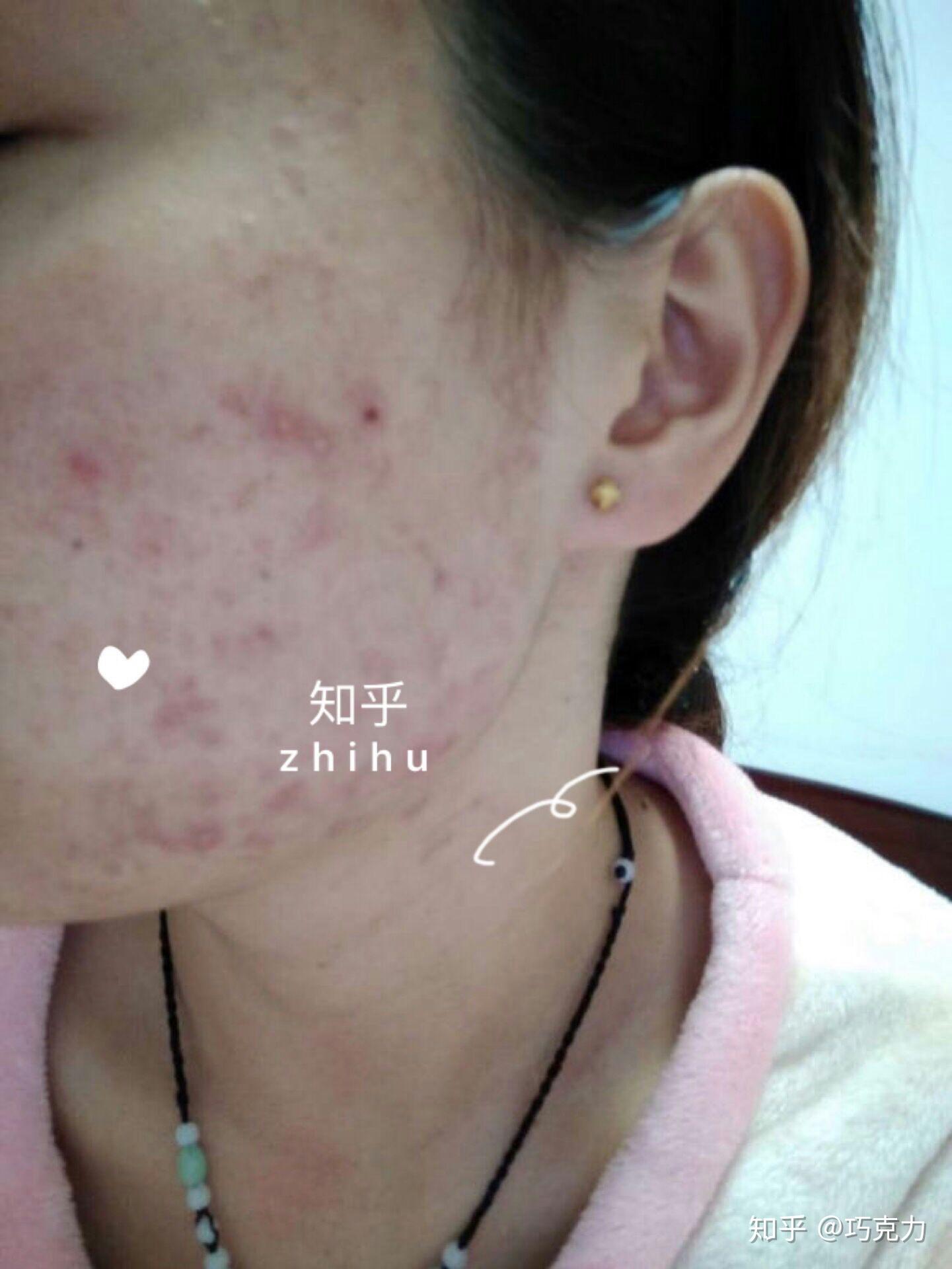 总是两腮长痘是怎么一回事?如何治疗啊