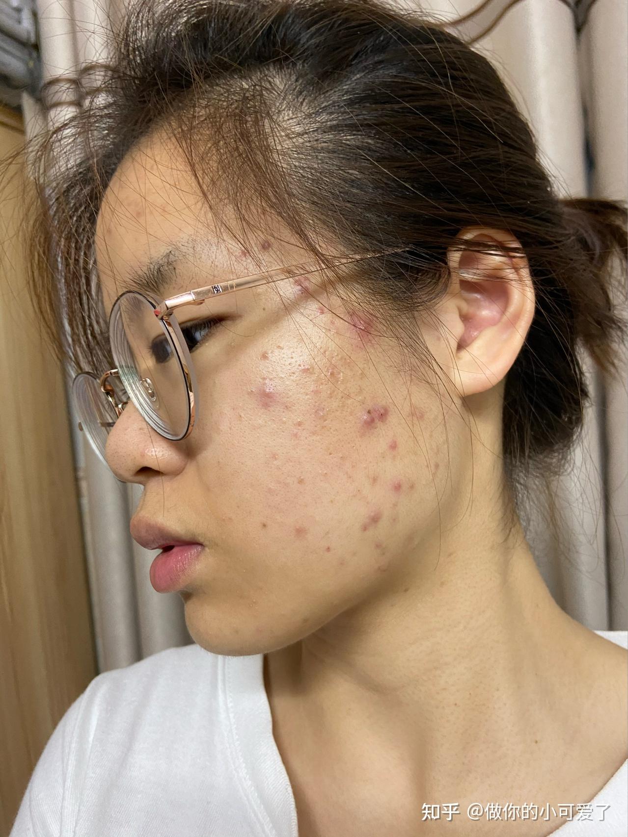 脸颊两侧长痘痘一直不消的原因是什么? - 知乎