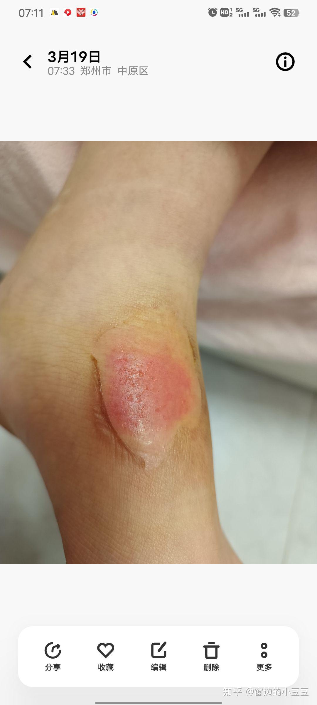 开水烫伤恢复过程