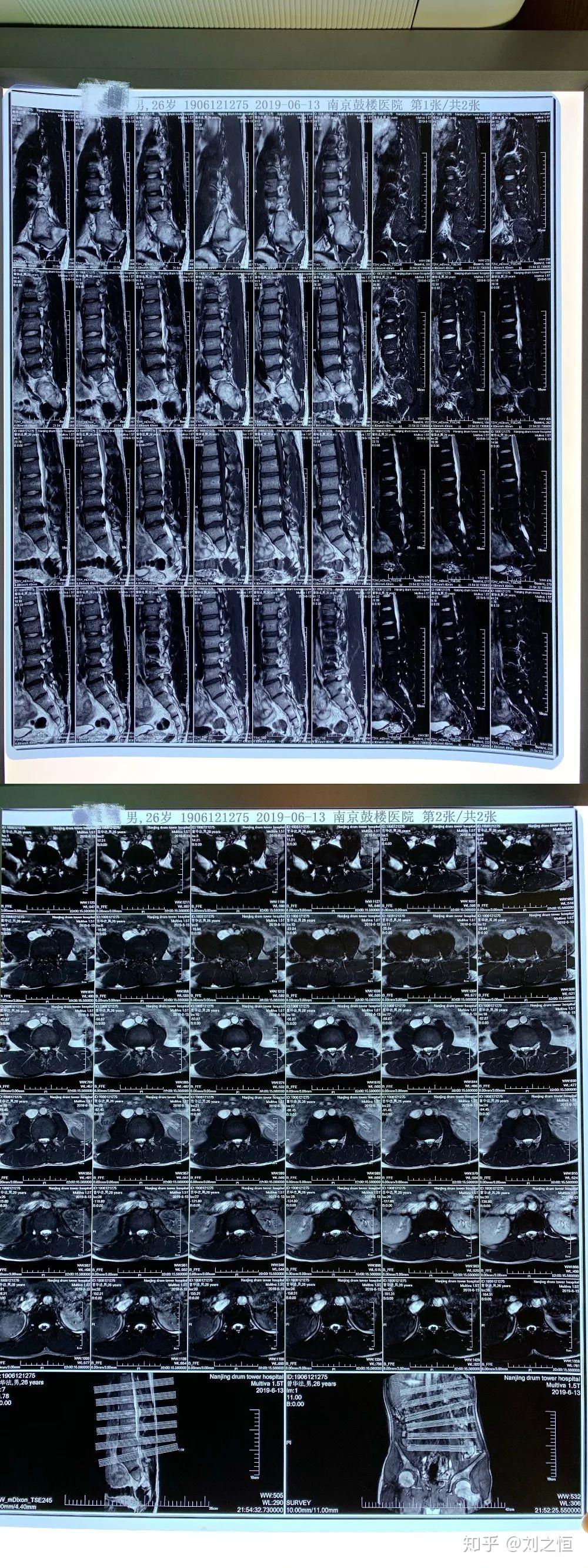 脊柱侧弯31,脊柱生理曲度变直,l4/l5,l5/s1椎间盘突出,压迫硬脊膜囊