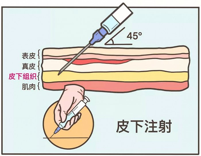 糖尿病打针部位图片