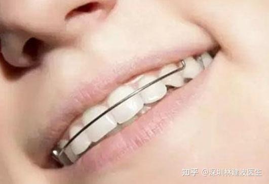 骨性龅牙用什么牙套更好?| 骨性