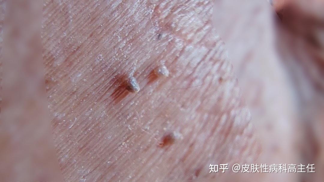阴囊处许多小肉粒是尖锐湿疣越传染越多吗？ - 知乎