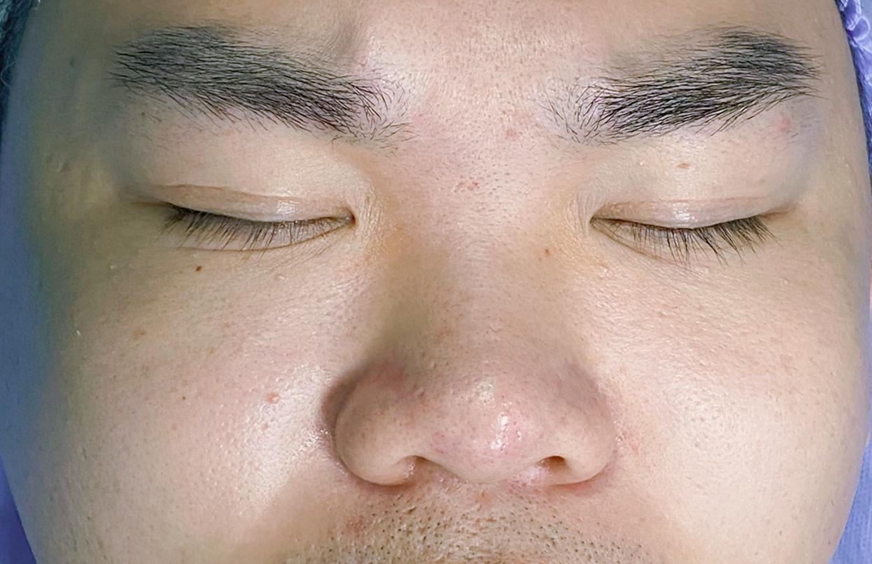 男生隆鼻+下巴 一个月反馈—李信锋隆鼻整形 - 知乎
