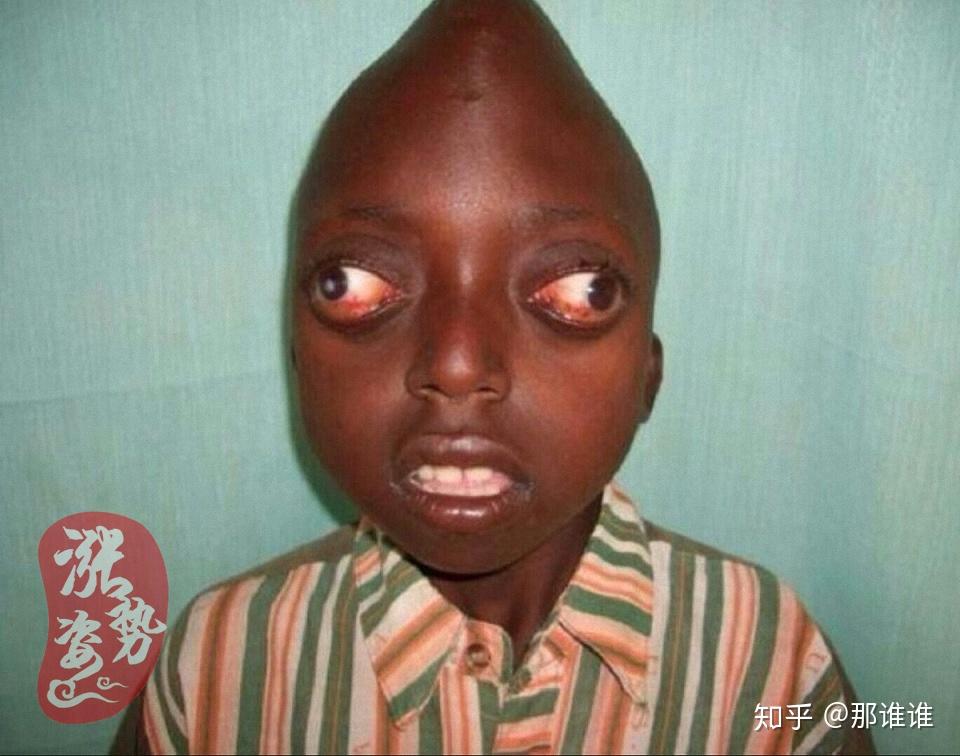 涨姿势第46弹10位恐怖的畸形人天黑后千万不要点开