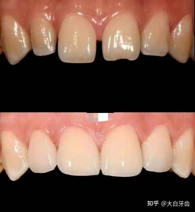 氟斑牙,四环素牙做瓷贴面好,还是做树脂贴面好?牙齿贴面多少钱?