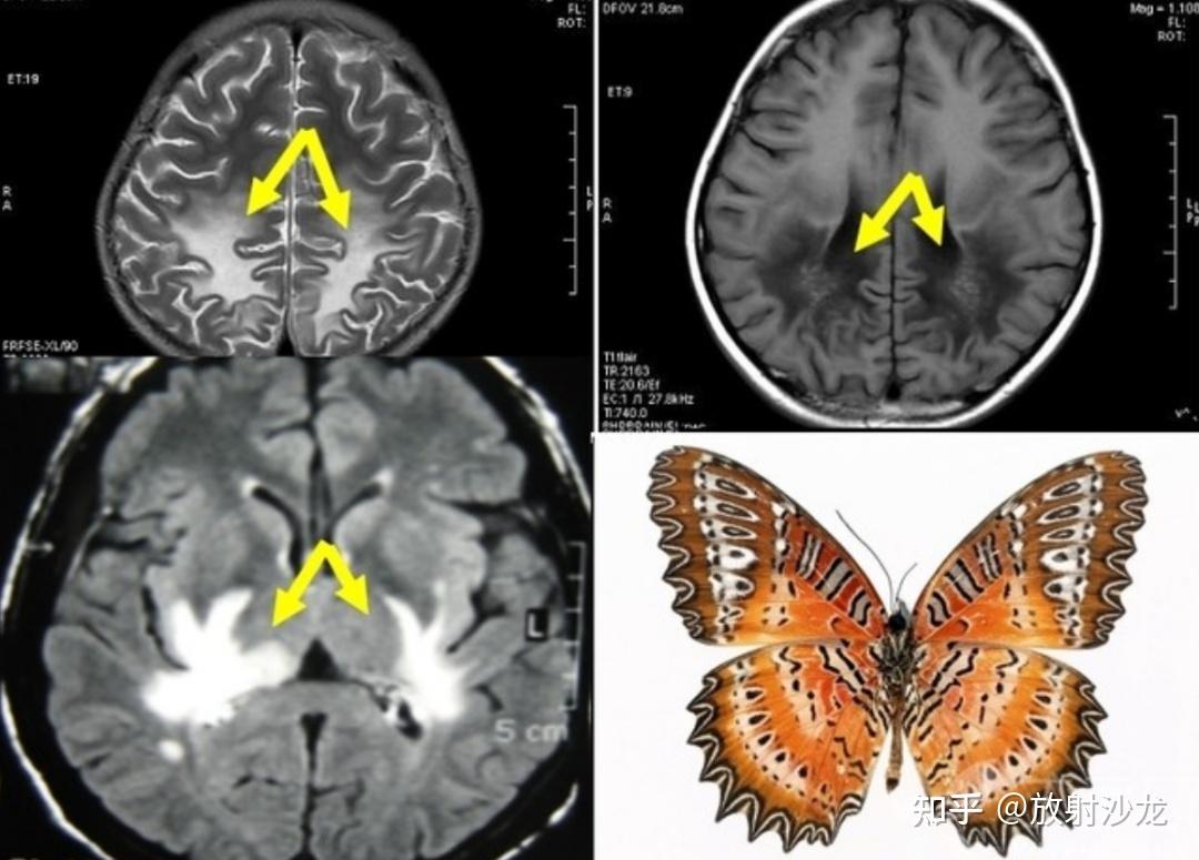 mri 表现:双侧脑室三角区周围对称分布的蝴蝶状异常信号影,在 t1wi 呈