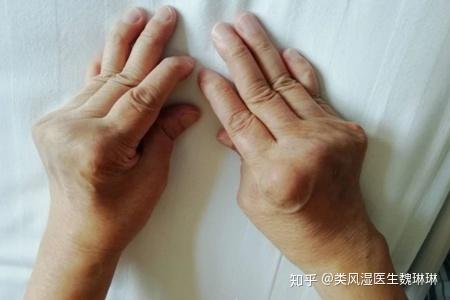 關節腫痛活動受限類風溼患者務必還要關注這8大症狀