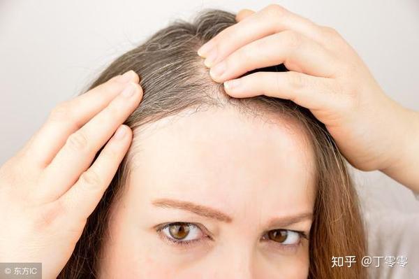 头顶上有白头发怎么办 知乎