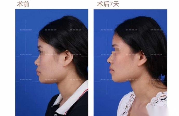 欧叔谈鼻:到底是假体还是肋软骨做鼻背好? - 知乎