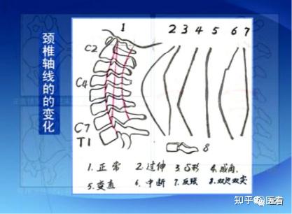 手把手教你在x线上如何测量「颈椎生理曲度变直」 知乎 