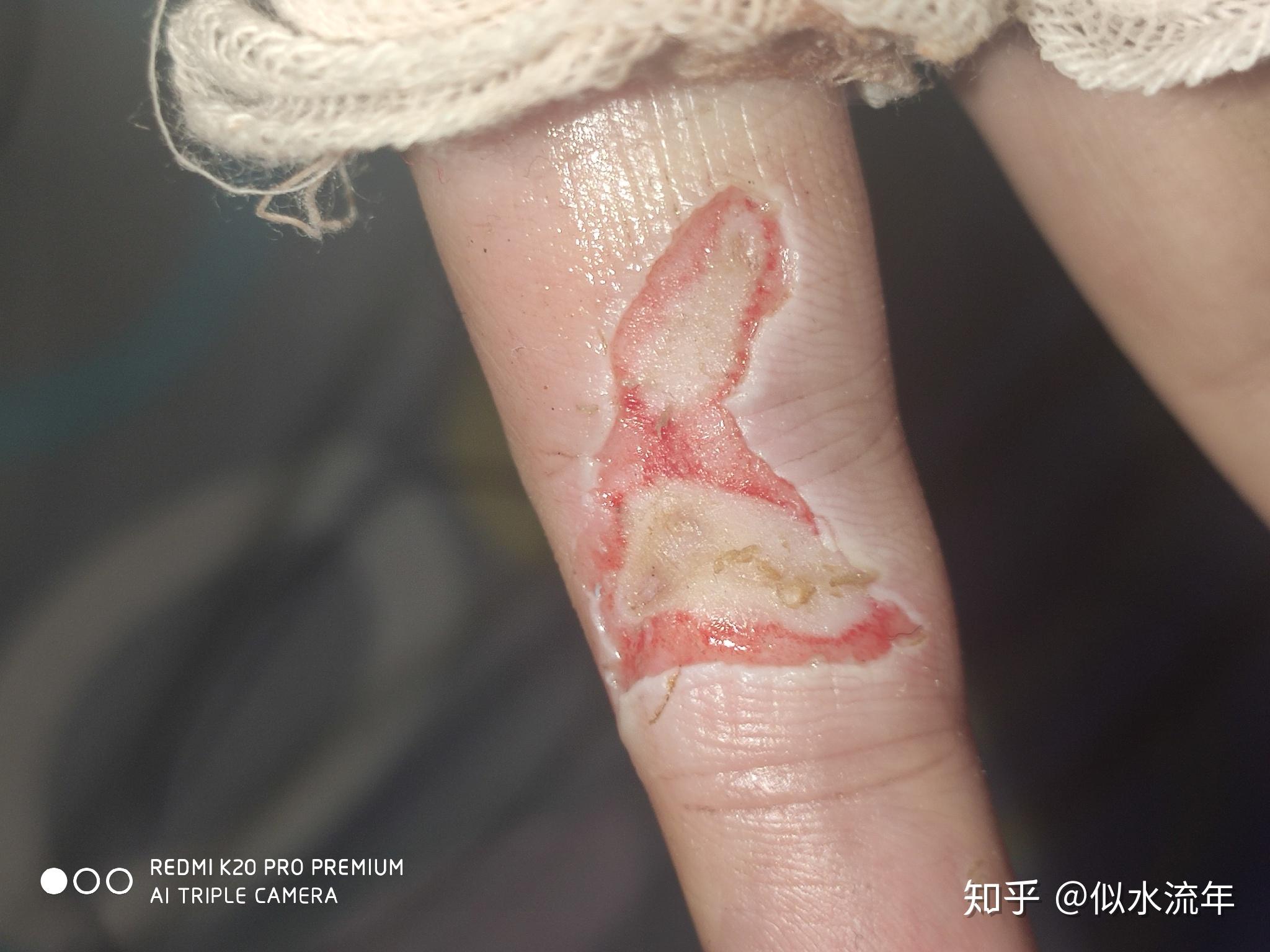 手被电伤了伤口肉坏死该怎么办