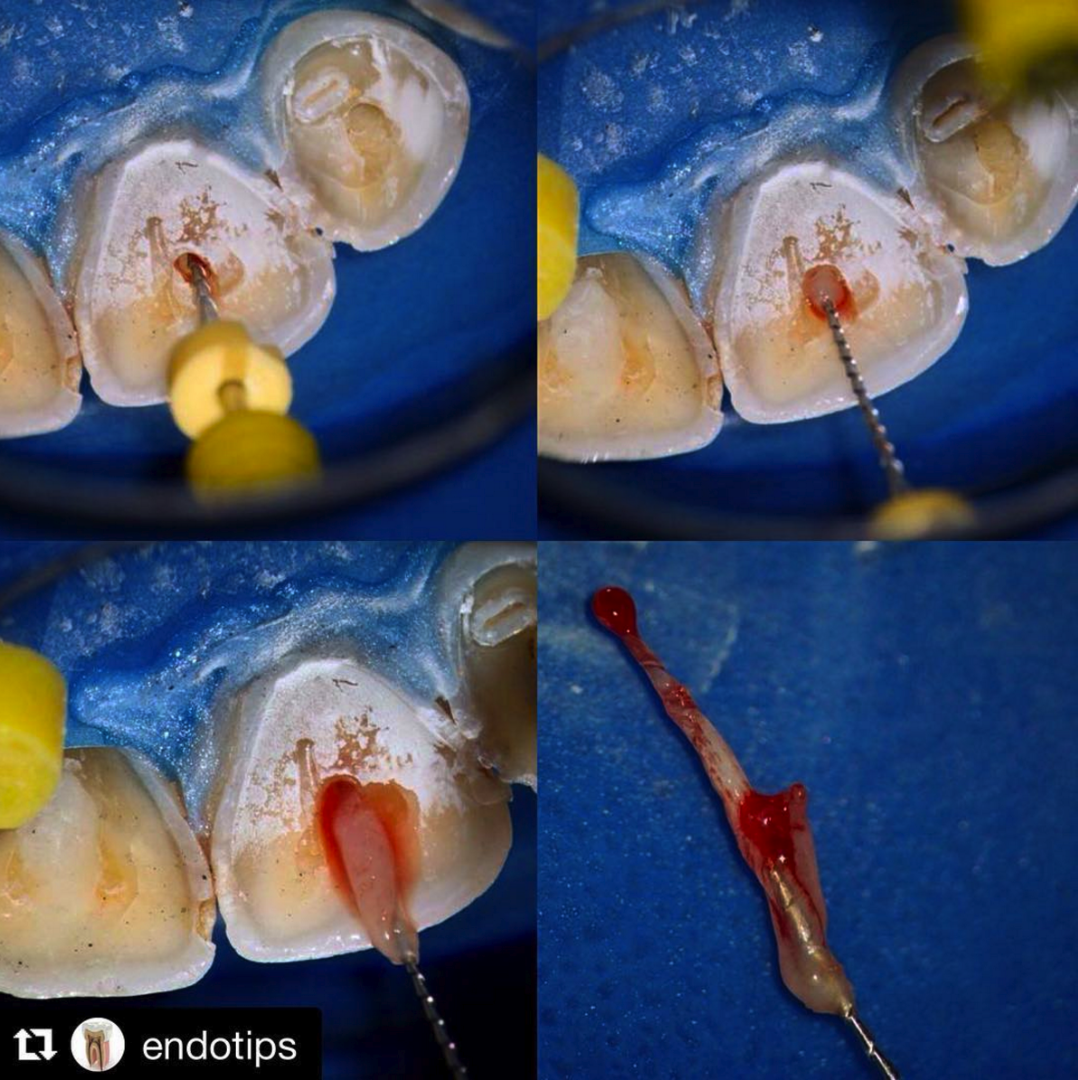 首发于67 人 赞同了该文章 根管治疗,杀神经,听着就疼. 也不便宜.