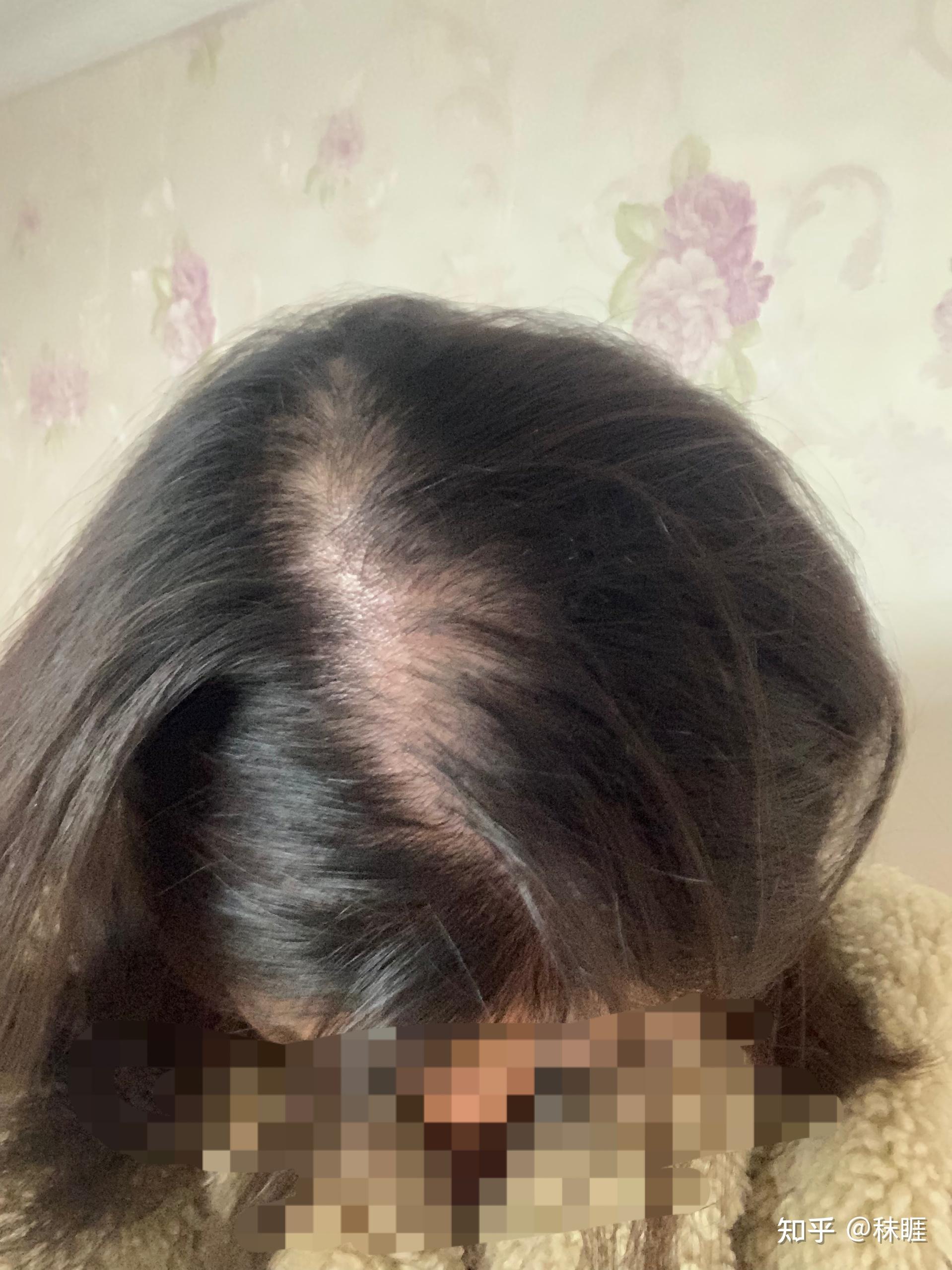 雄性激素型秃发治疗打卡第一天 - 知乎