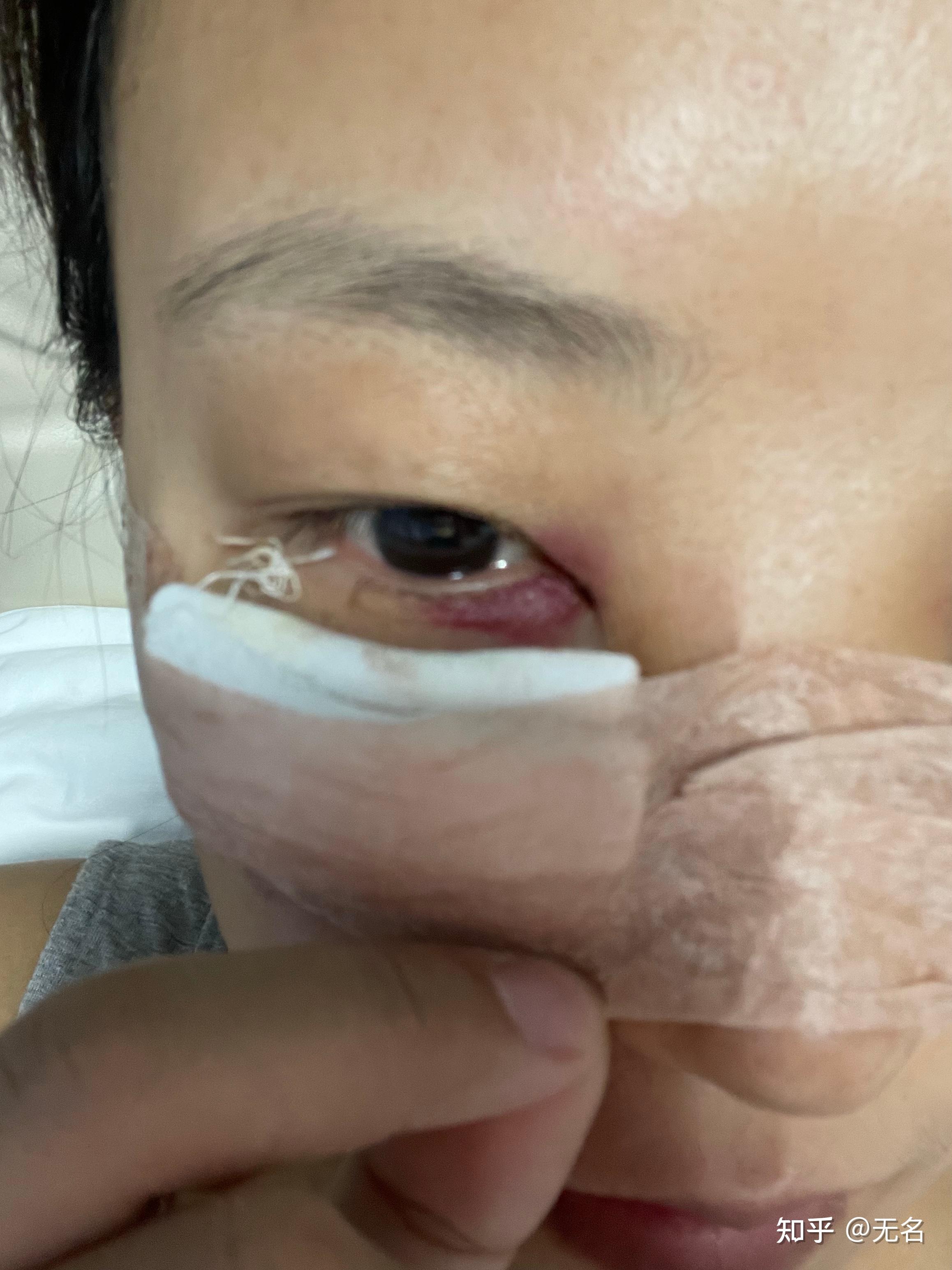 内切眼袋经验分享 - 知乎