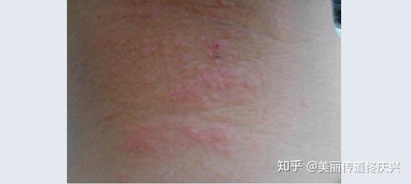 阳光晒到就起红疹,到底是何原因? - 知乎