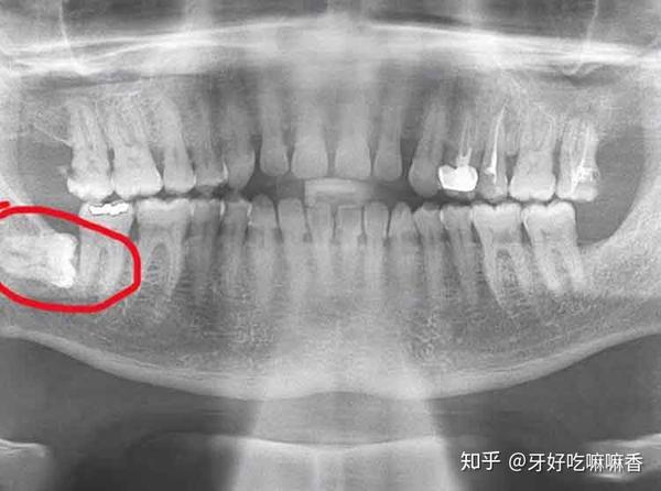 拔掉智齿是怎样的一种体验 知乎