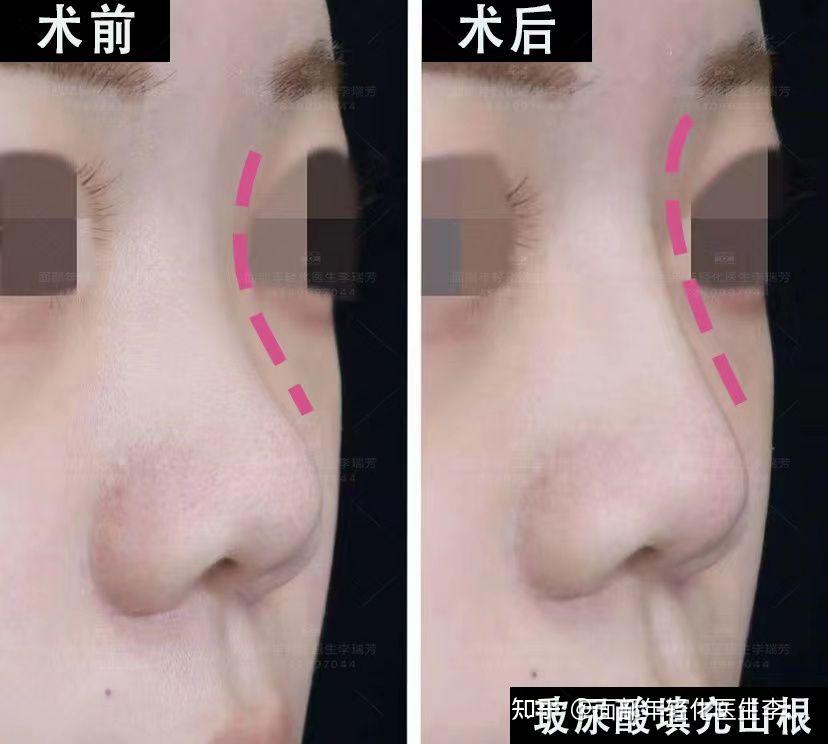 玻尿酸注射山根