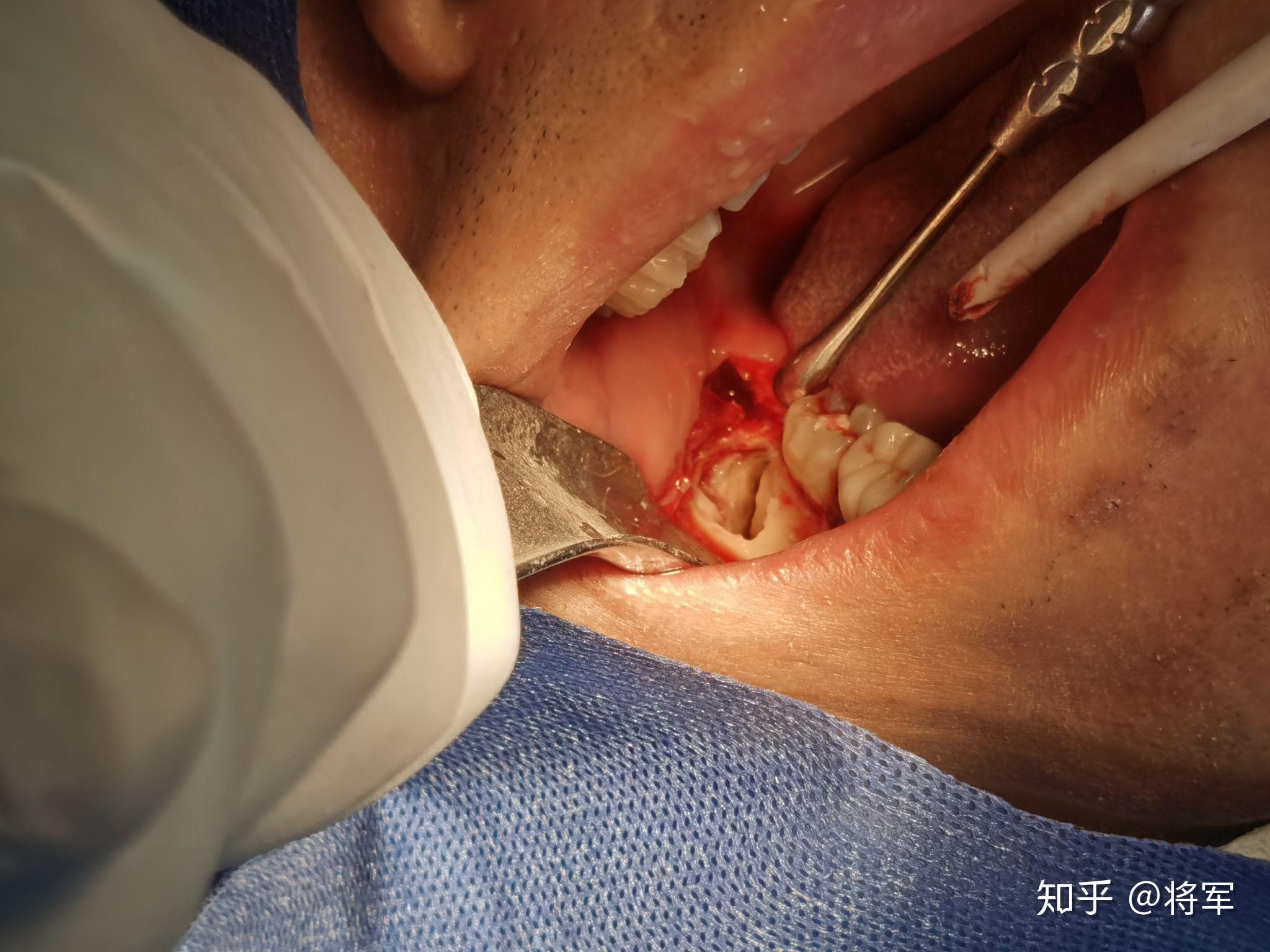 想为自己打波广告成都医学院第一附属口腔科可以快速安排阻生牙拔除在