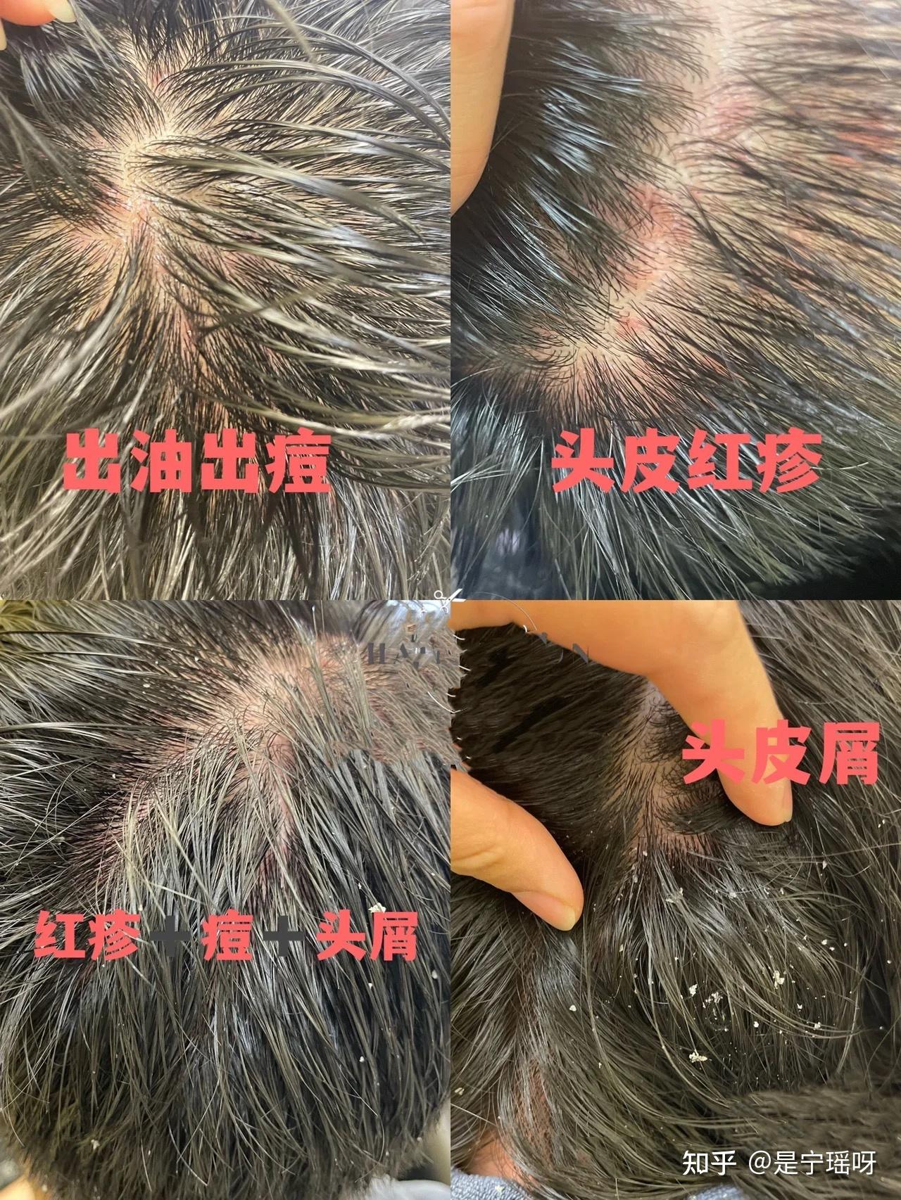 头皮油腻瘙痒、头皮屑疯涨、掉发多,有小红点,这些都是螨虫引起的吗?有那些在医学生眼中特别好用的除螨洗发水推荐? - 知乎