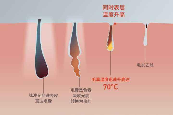 家用光学脱毛仪的原理