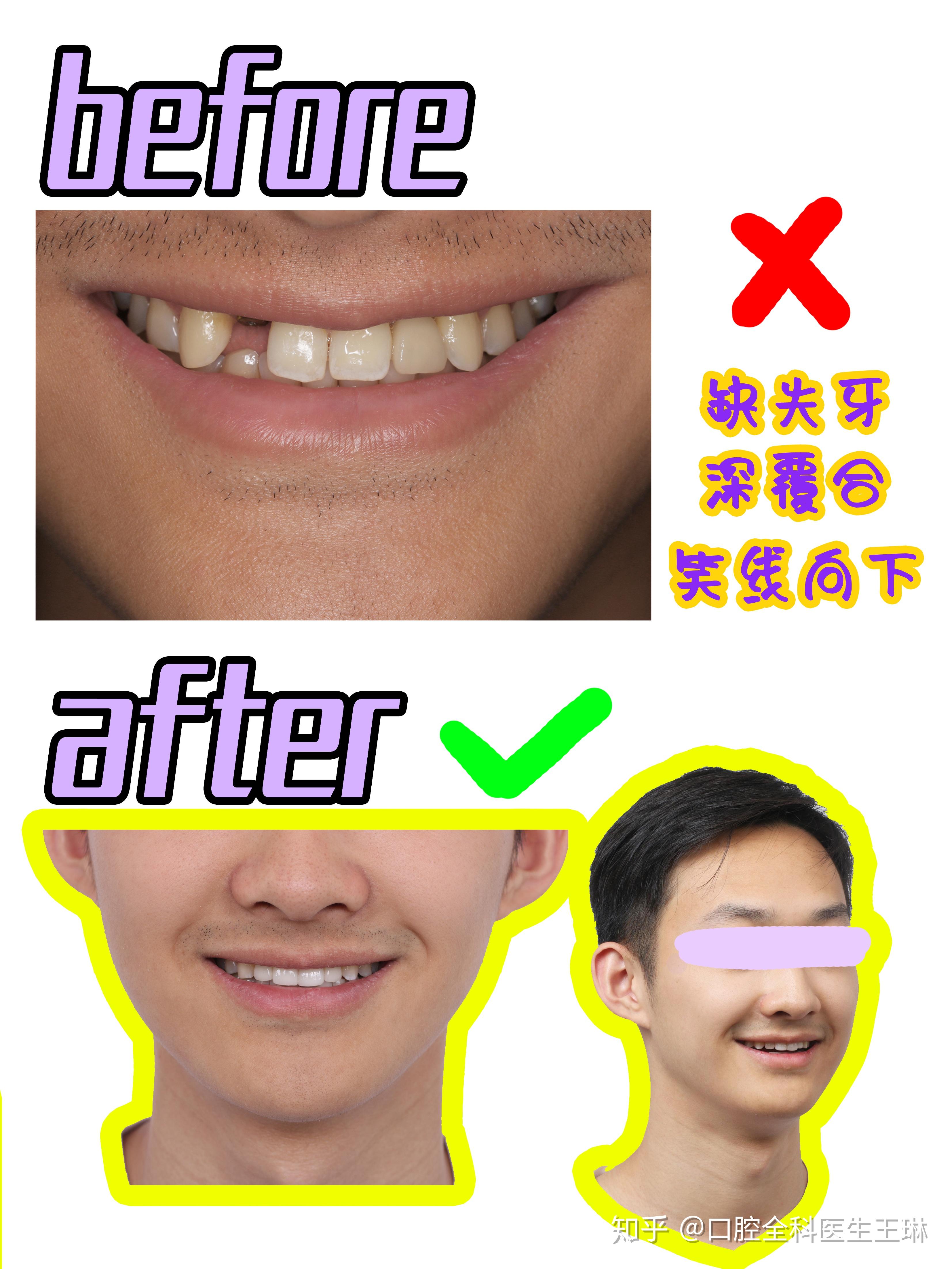 先天缺牙｜日本首創「牙齒再生」藥物 有望治療先天性缺牙症患者｜醫師Easy