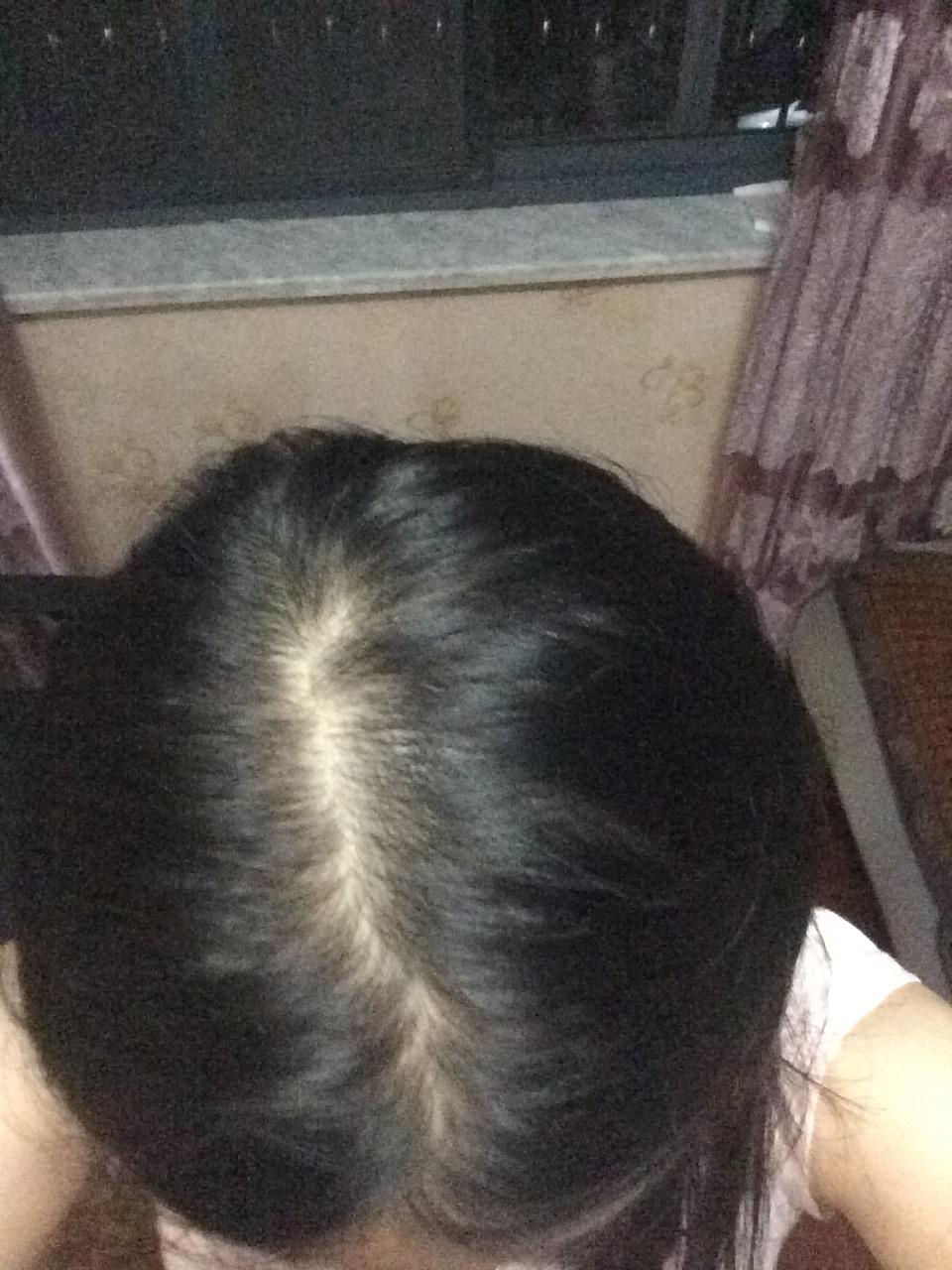 女生22,三年前发现头发越来越少,头发细软少,医