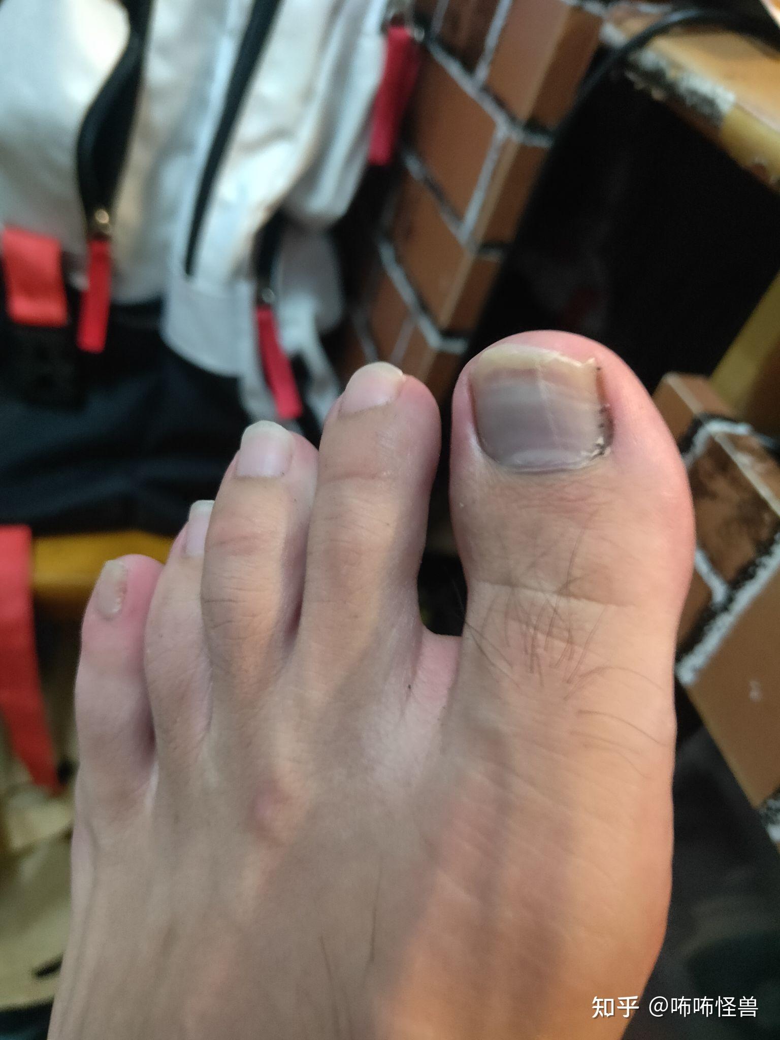脚趾甲瘀血恢复过程（图片可能引起不适） - 知乎