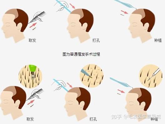 植发业内大公开，22年植发一定要了解的事：植发后成活的关键？植发后如何护理？ - 知乎