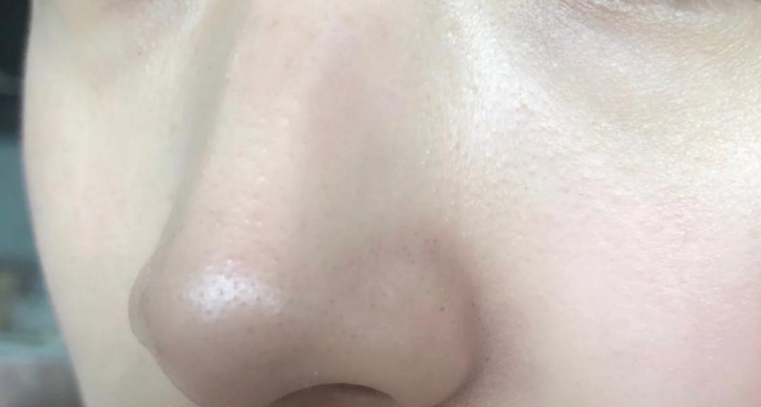 如何去除鼻子上的黑头