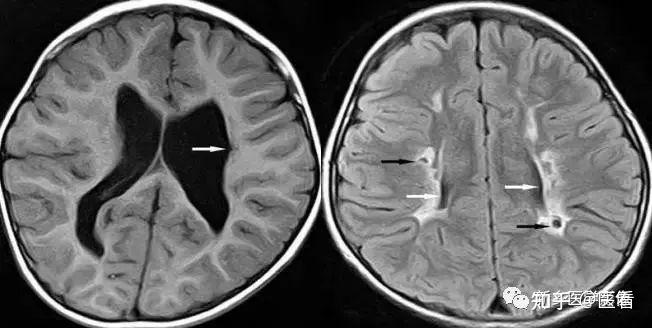 影像学示脑室扩大有哪些原因?全在这篇文章里