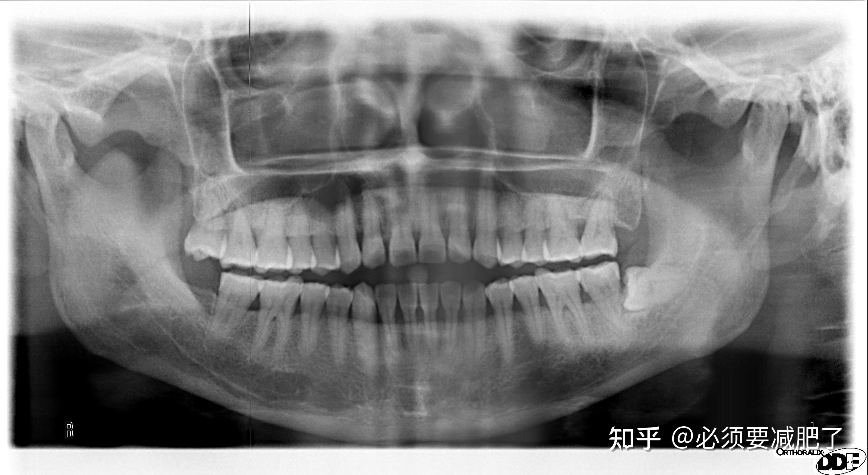 智齿到底拔不拔