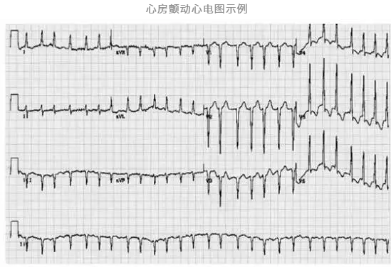 心室率绝对不规整,qrs波群表现为绝对不整齐,形态不一,脉搏可发现短绌