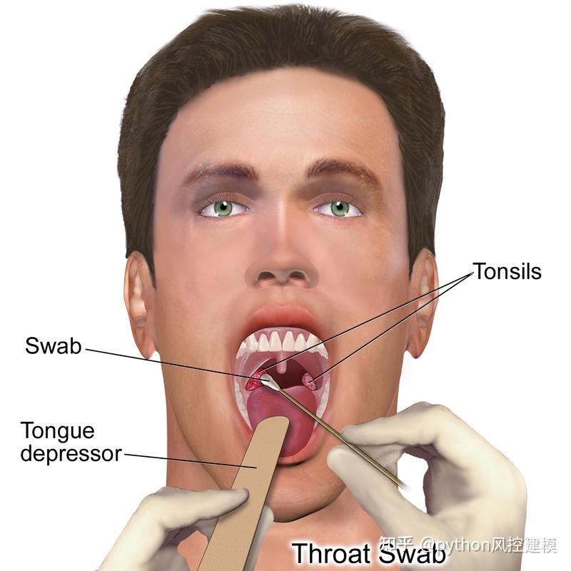 一圖讀懂慢性咽喉炎chronic pharyngitis - 知乎