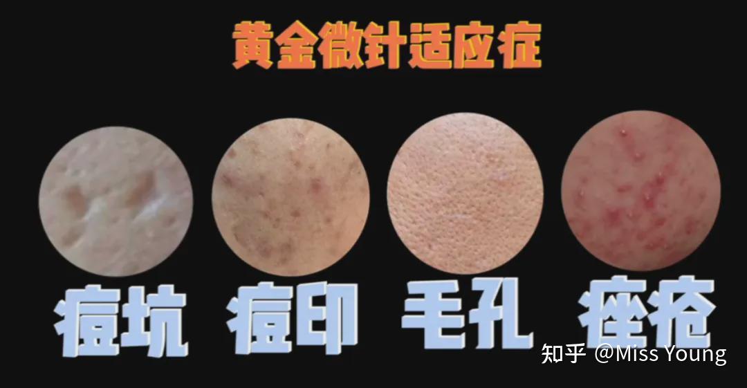 迷死氧实验室治痘坑专业户黄金微针测评分享