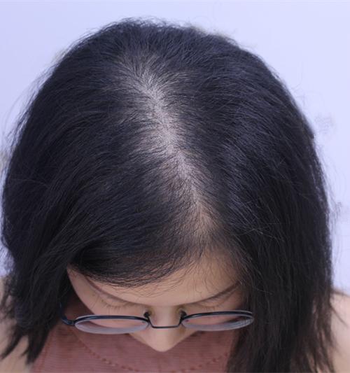 女生头顶头发少是什么体验