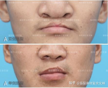 唇裂鼻专家余文林:不一定!