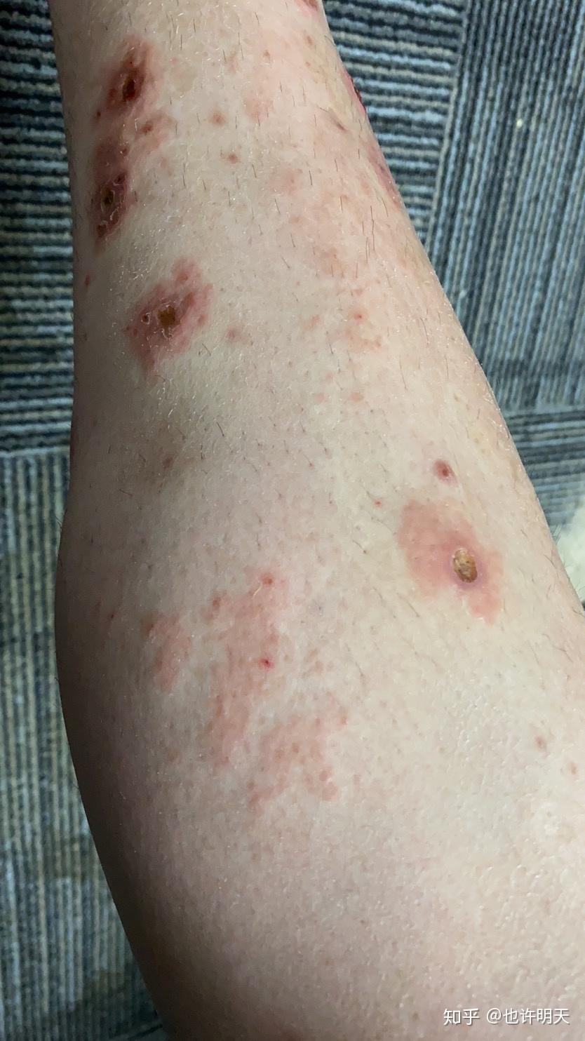 变应性皮肤血管炎怎么治疗危害大不大