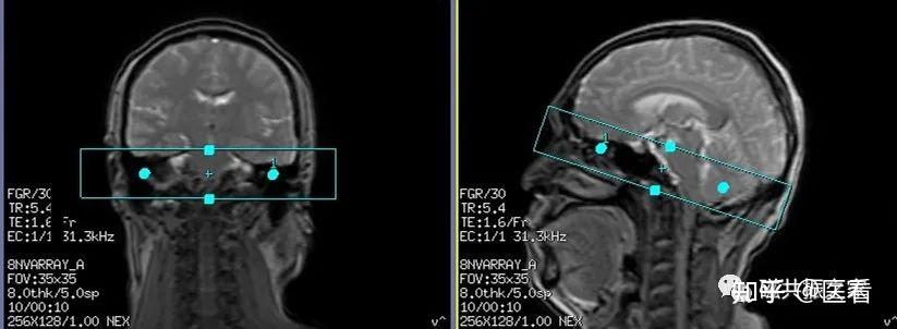 内听道磁共振解剖图图片