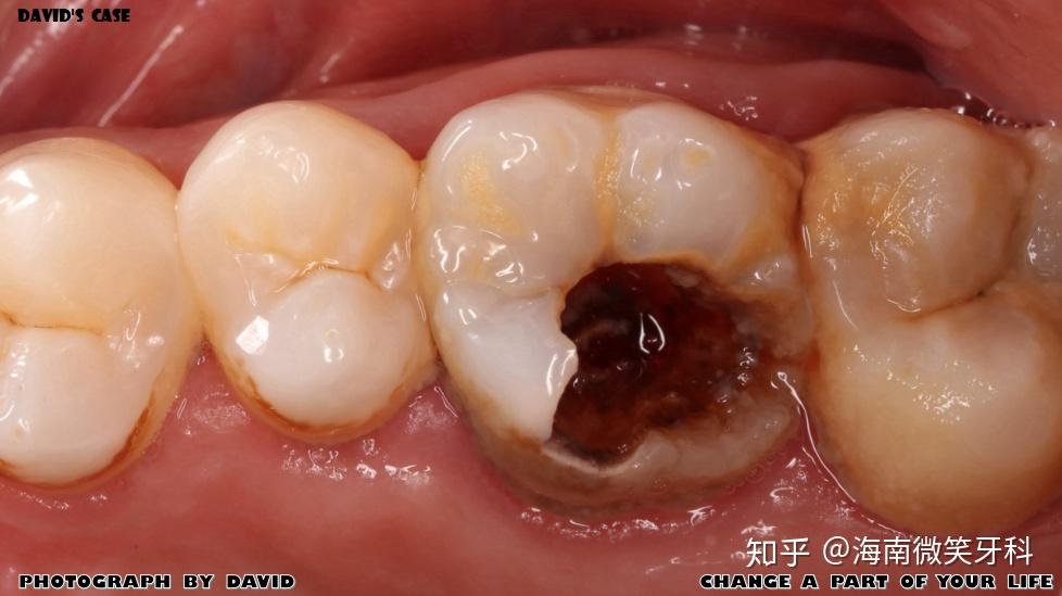 牙体缺损极佳修复方式嵌体