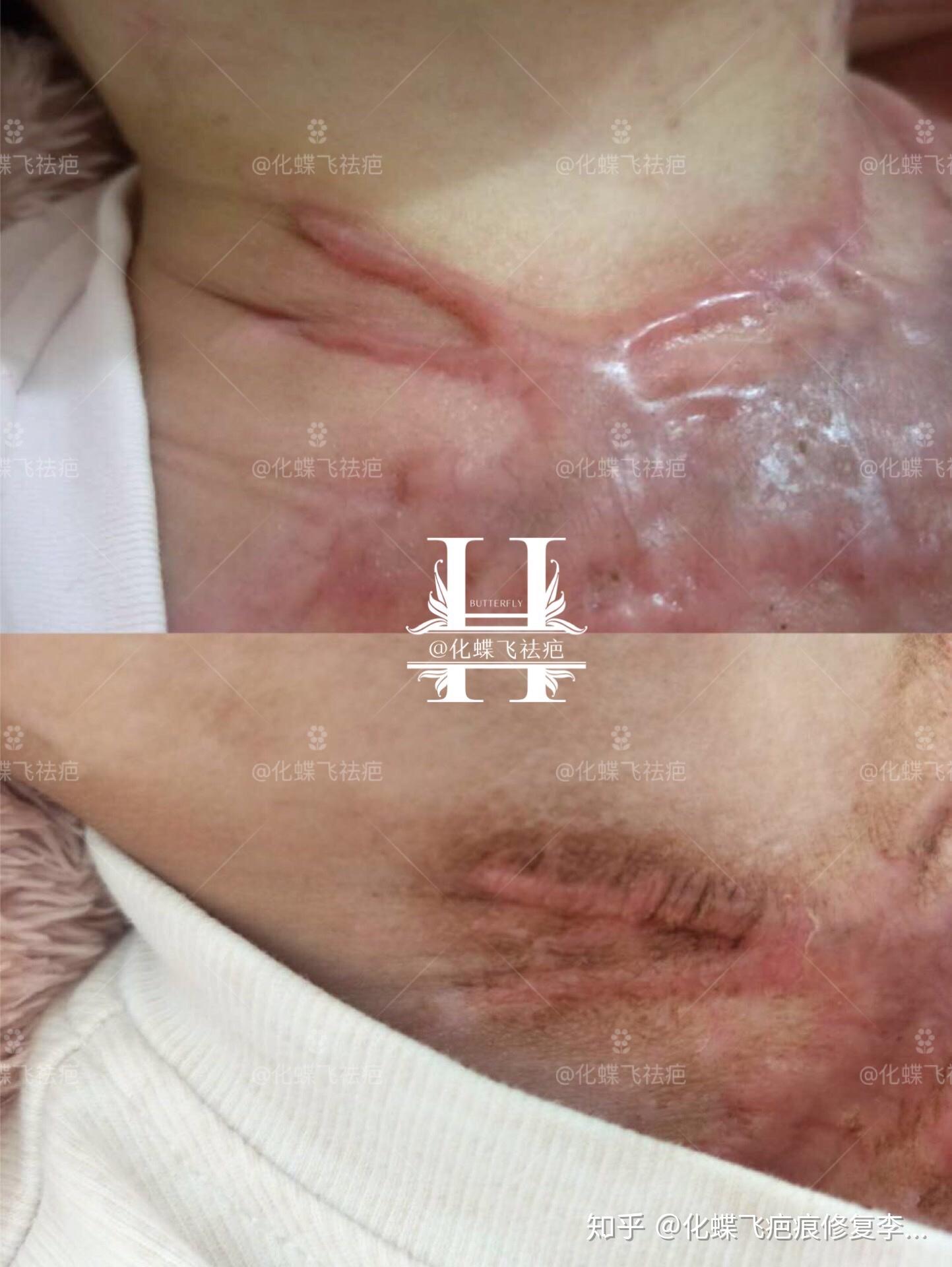 宝宝烫伤严重的疤痕增生可以修复吗