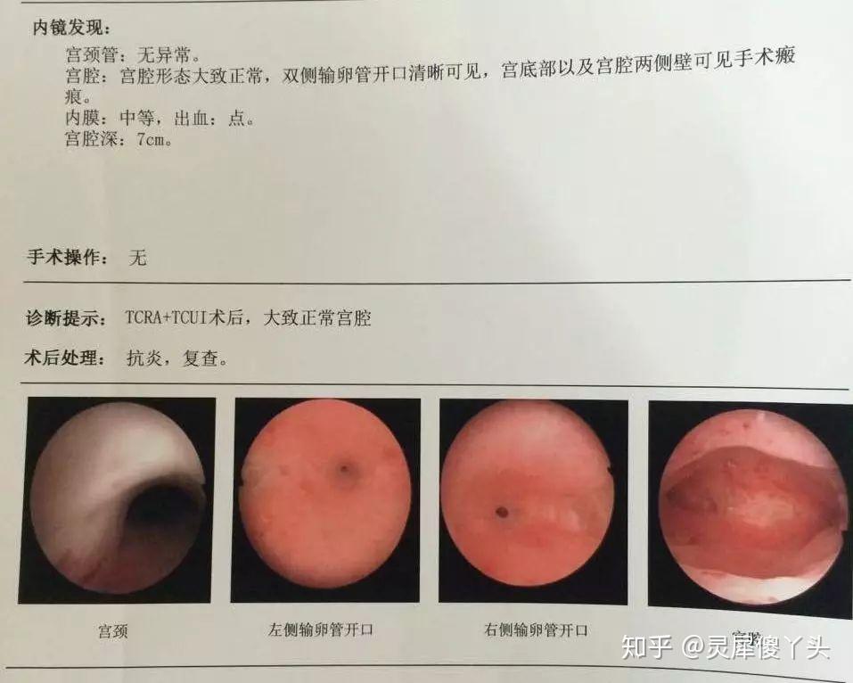 好孕学姐分享5宫腔粘连不要怕调理好体质一定能怀上